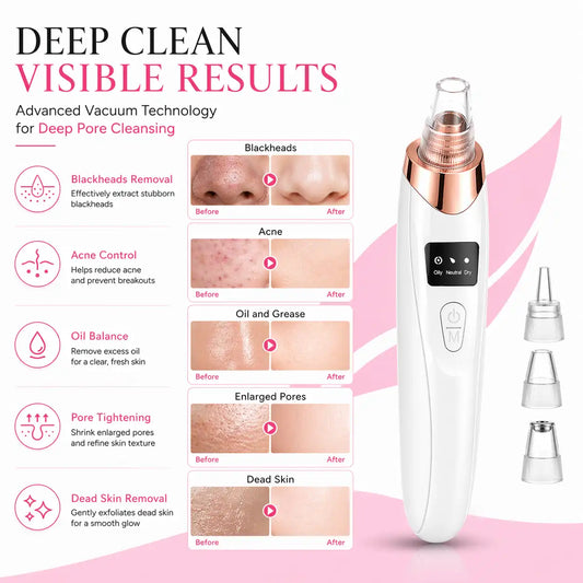 Glamera 5-in-1 Blackhead Remover Vacuum